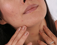 Bij acne denk je misschien eerder aan jongeren en puberteit, maar veel vrouwen (en in veel mindere mate mannen) van zeg tussen de 25 en 40 jaar hebben nog steeds last van puistjes, zwarte puntjes, grove poriën en acne littekens.