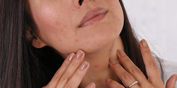 Bij acne denk je misschien eerder aan jongeren en puberteit, maar veel vrouwen (en in veel mindere mate mannen) van zeg tussen de 25 en 40 jaar hebben nog steeds last van puistjes, zwarte puntjes, grove poriën en acne littekens.
